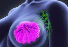 Breast Cancer in Nigeria