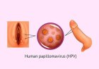 What Are Genital Warts?