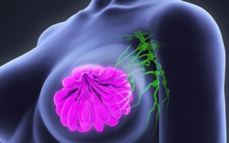 Breast Cancer in Nigeria