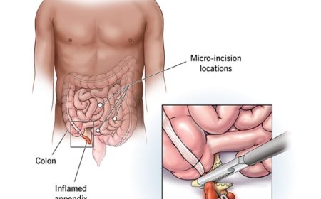 Appendicitis Operation