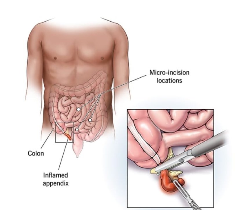 Appendicitis Operation