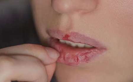 Chapped Lips (Cheilitis)