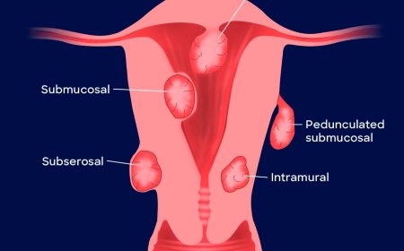 Uterine Fibroids: Prevalence, Symptoms, and Prevention