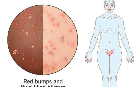 Herpes: Types and Transmission