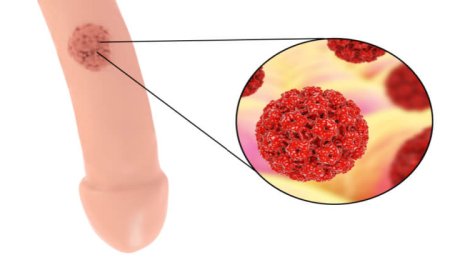 How to Get Rid of External Genital Warts