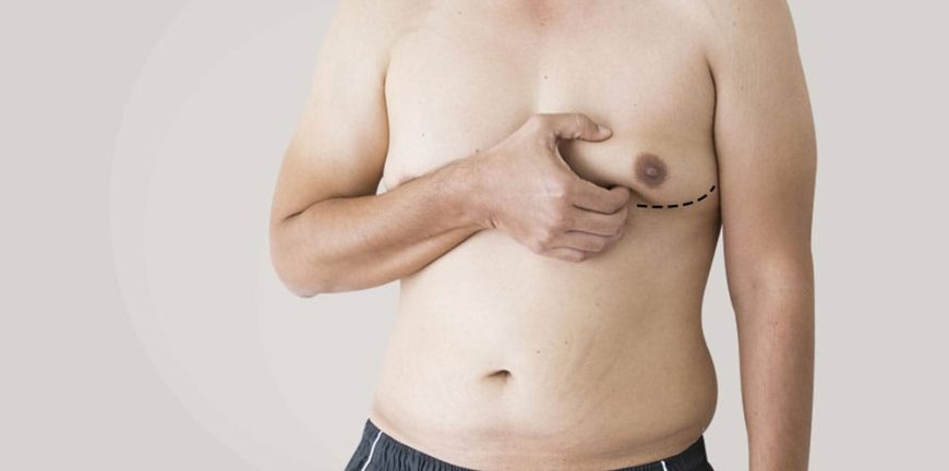 Gynecomastia _ Male Breast Enlargement