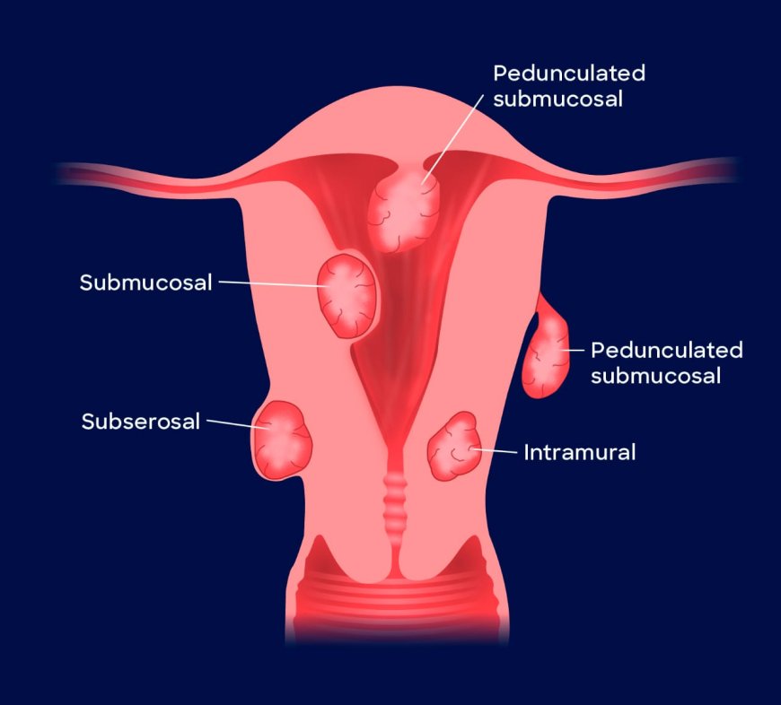 Uterine Fibroids: Prevalence, Symptoms, and Prevention