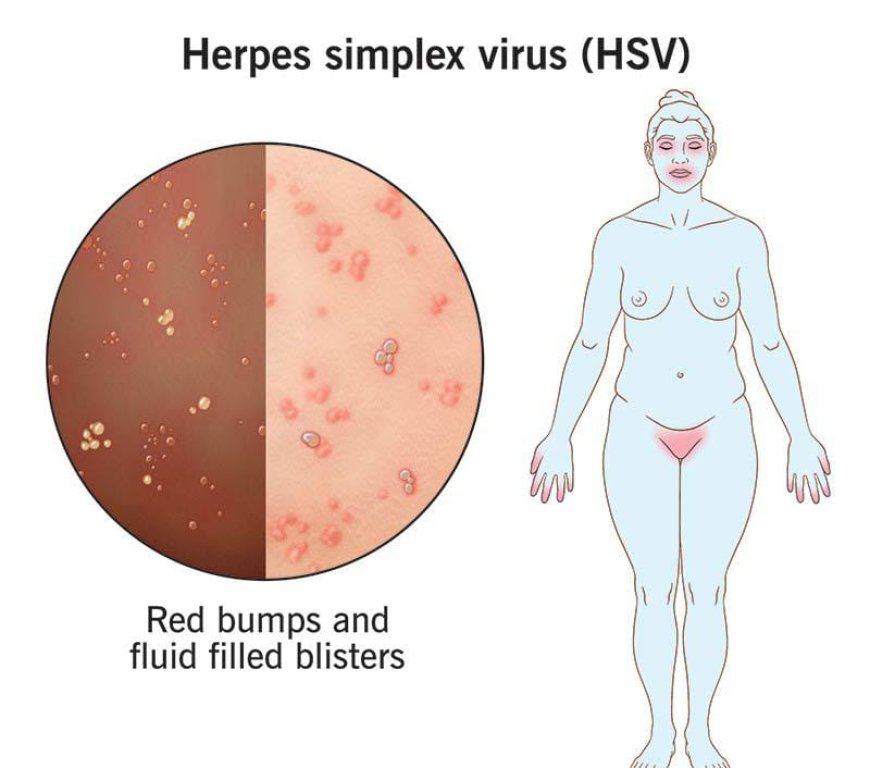 Herpes: Types and Transmission