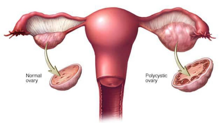 Polycystic Ovarian Syndrome (PCOS)