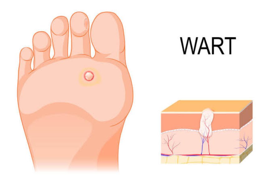 Effective Treatments for Warts