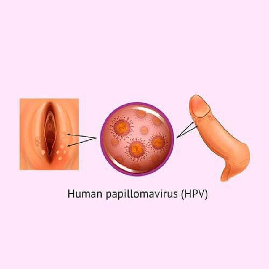 Genital warts, caused by certain strains of the human papillomavirus (HPV), can indeed be a significant public health concern.