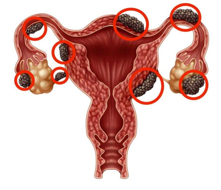 Endometriosis is a chronic and often painful condition in which tissue similar to the lining of the uterus (endometrium) grows outside the uterus