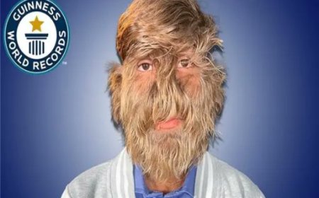 Indian Teen Sets Guinness World Record for Hairiest Face
