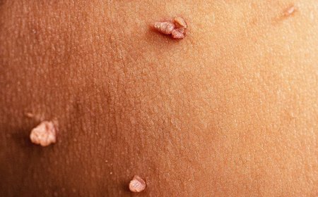 *Genital warts in men are primarily caused by the human papillomavirus (HPV), particularly types 6 and 11.