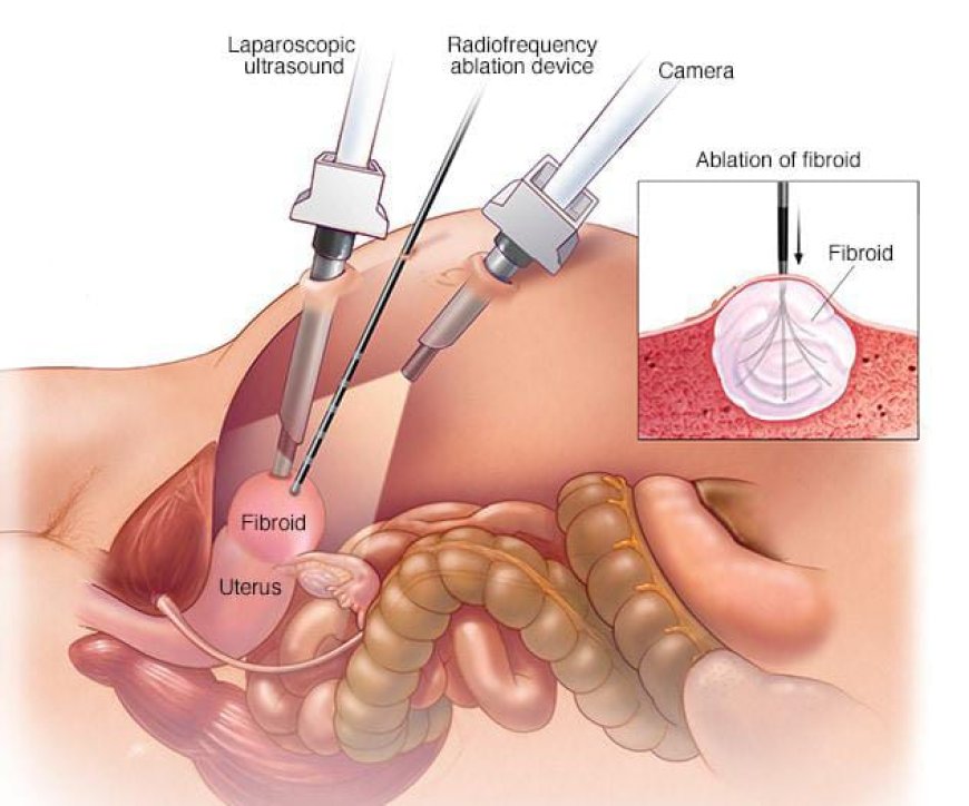 *Fibroids Prevention and Treatment*