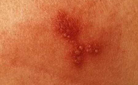 Herpes Virus Presentation