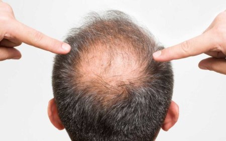 Young men can take steps to potentially avoid baldness*