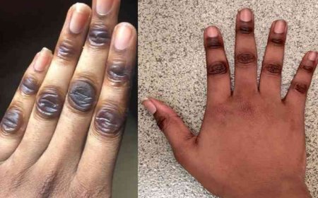 *How to Clear Dark Knuckles*
