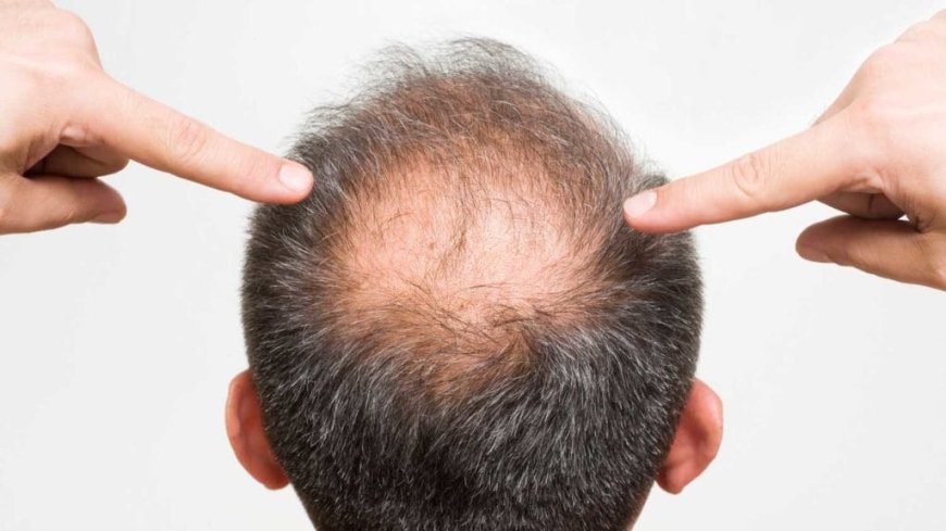 Young men can take steps to potentially avoid baldness*