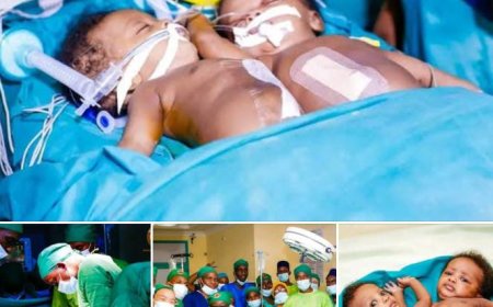 Burundi Records Medical Breakthrough as Siamese Twins Successfully Separated