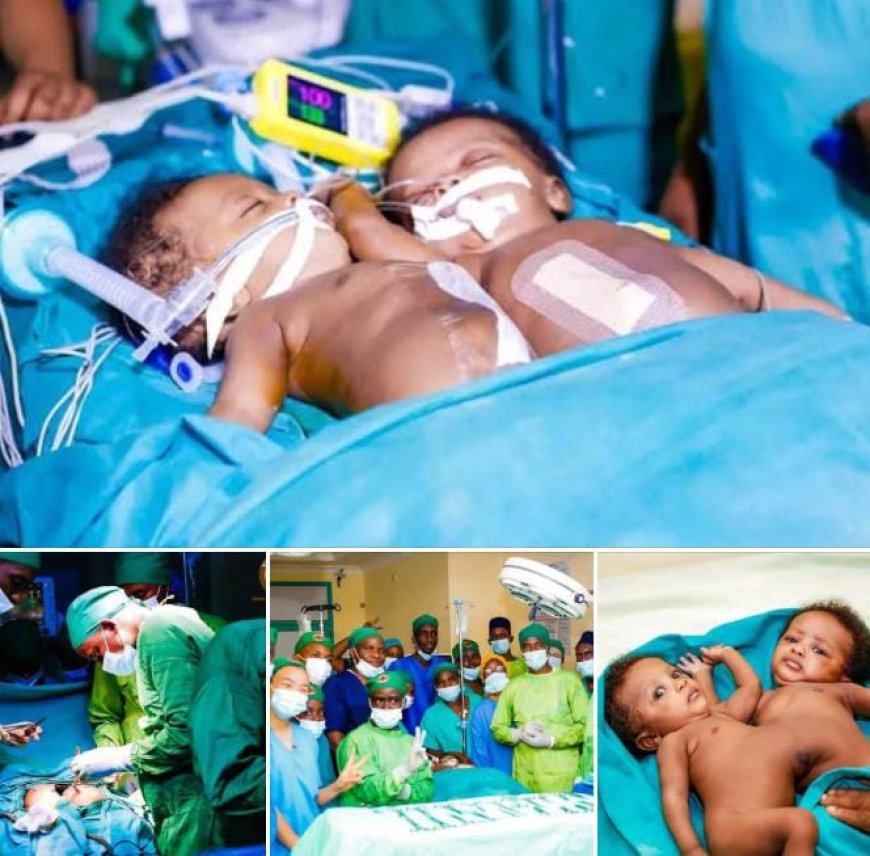 Burundi Records Medical Breakthrough as Siamese Twins Successfully Separated